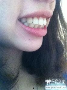 国产牙套会碎吗图片视频,揭秘碎裂真相