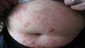 国产干扰素注射视频,视频教学解析